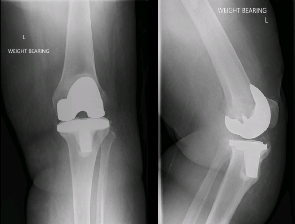 Revision-Knee-Replacement-Surgery-img1