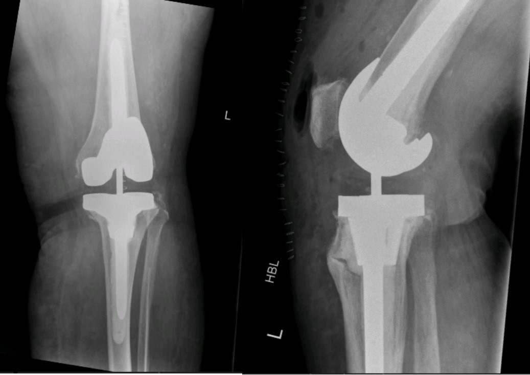 Revision-Knee-Replacement-Surgery-img2