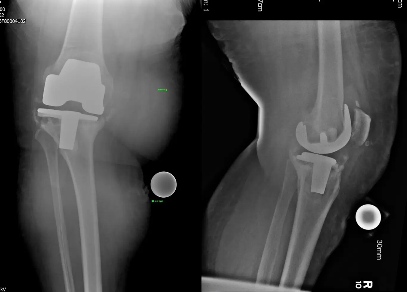 Revision-Knee-Replacement-Surgery-img3