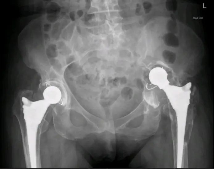 Revision-Hip-Replacement-Surgery-picture-1
