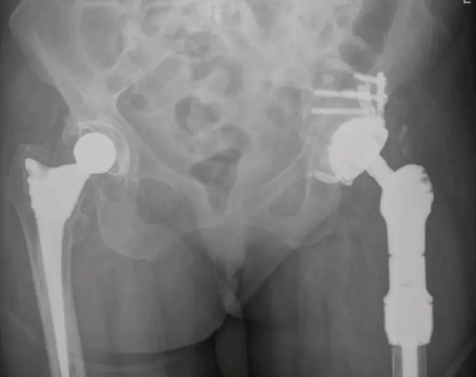 Revision-Hip-Replacement-Surgery-picture-2