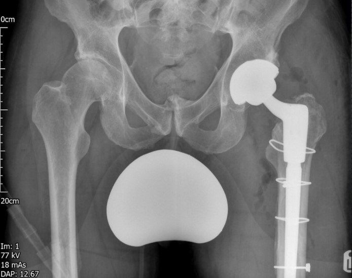Revision-Hip-Replacement-Surgery-picture-3