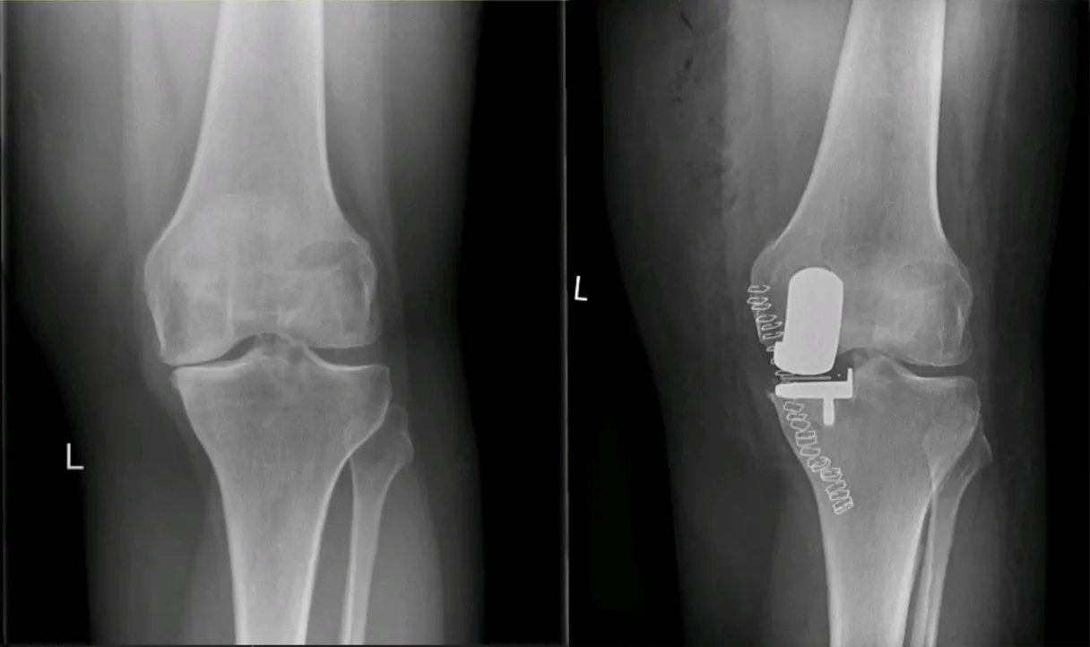 partial-knee-replacement-img